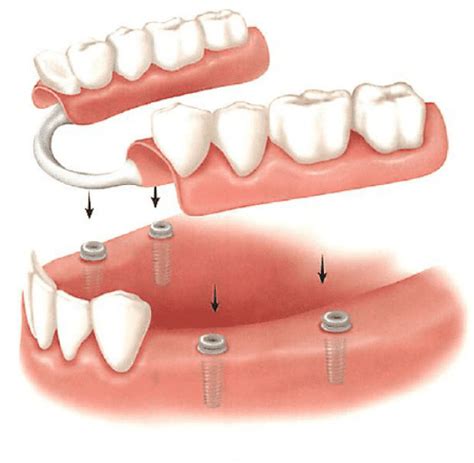 removable partial dentures implant support